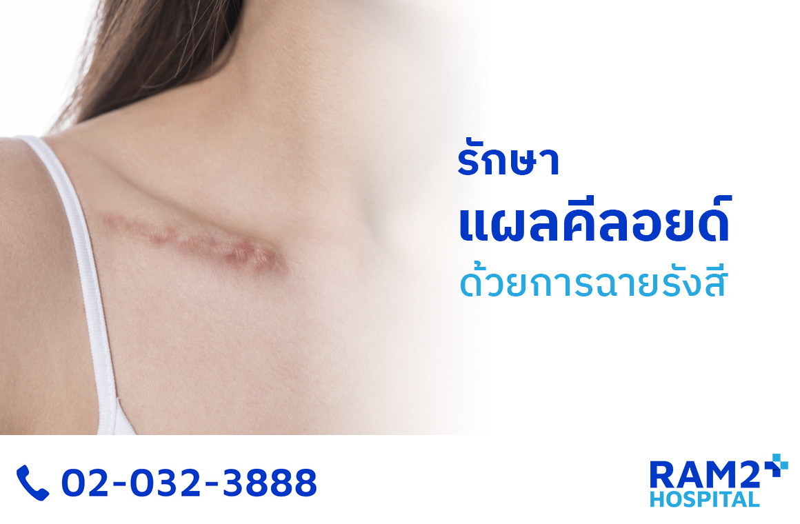 แผลคีลอย รักษา
