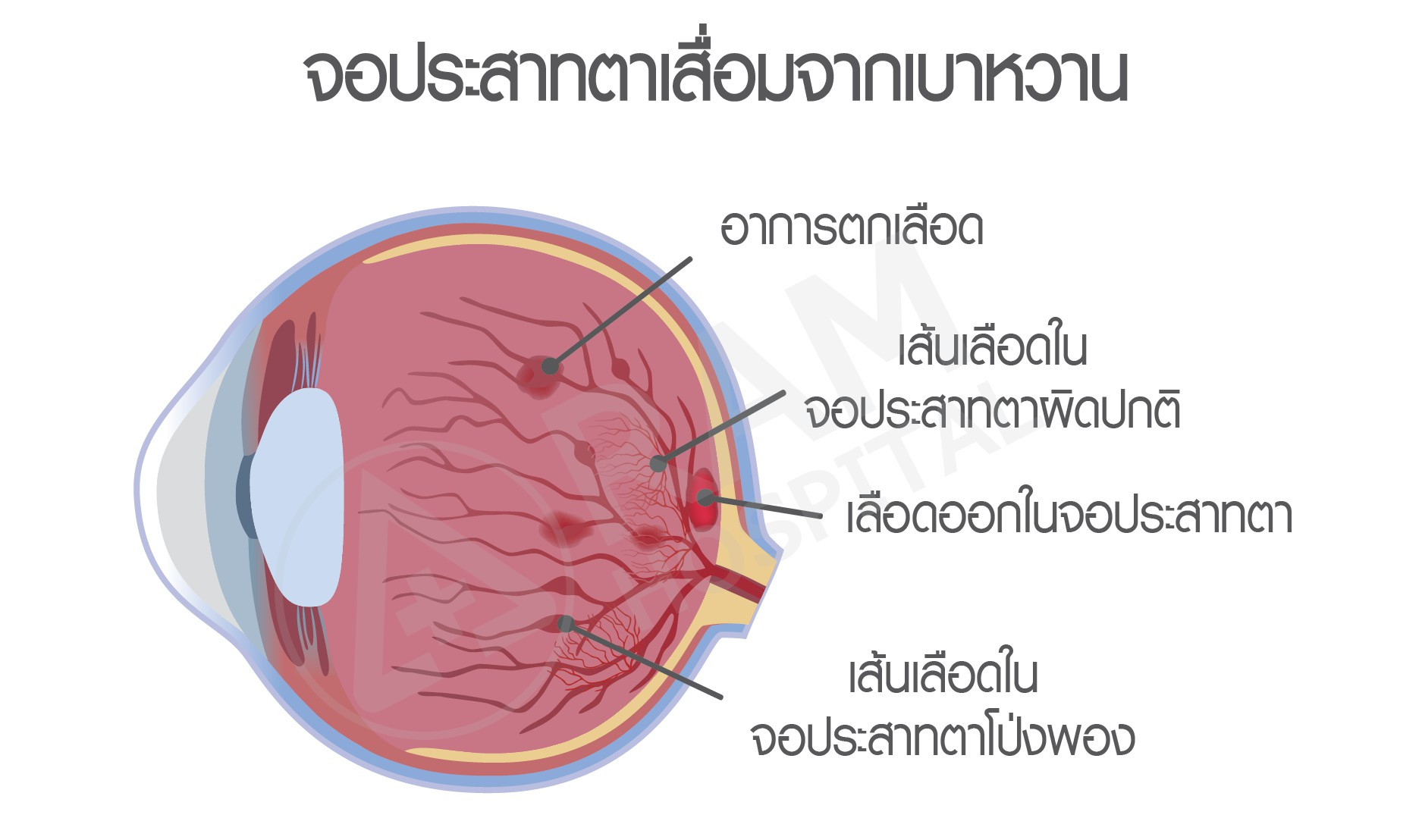 เบาหวานขึ้นตา