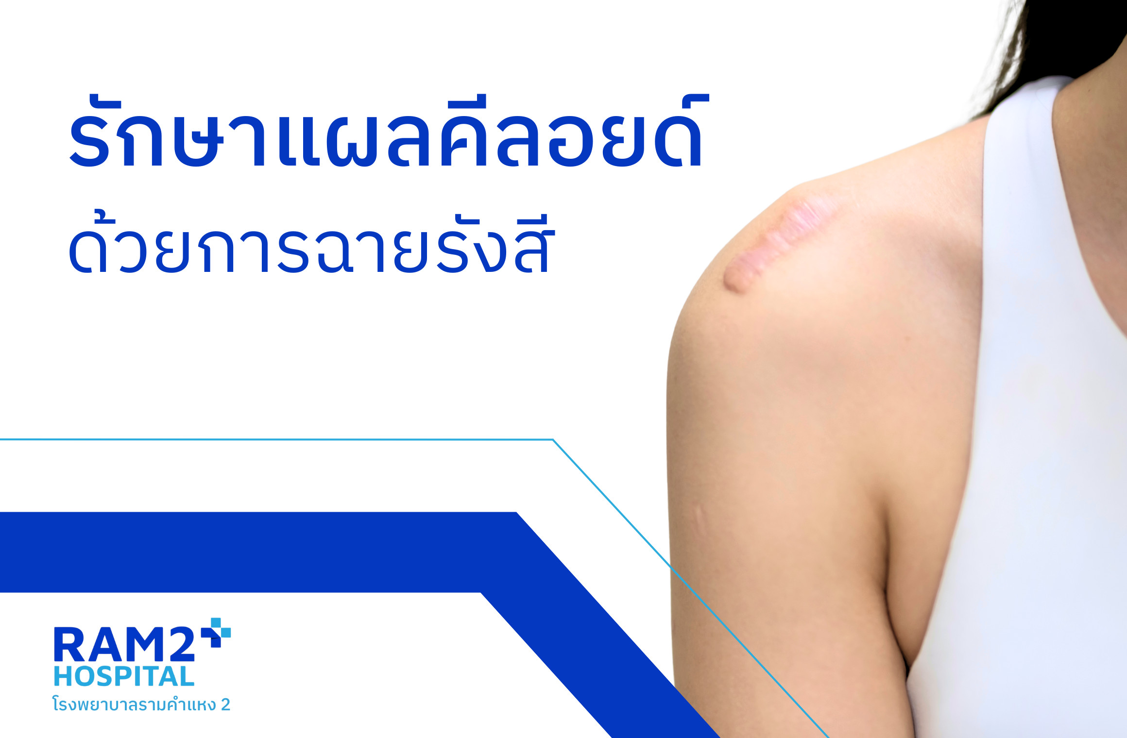 รังสีรักษาคีลอยด์