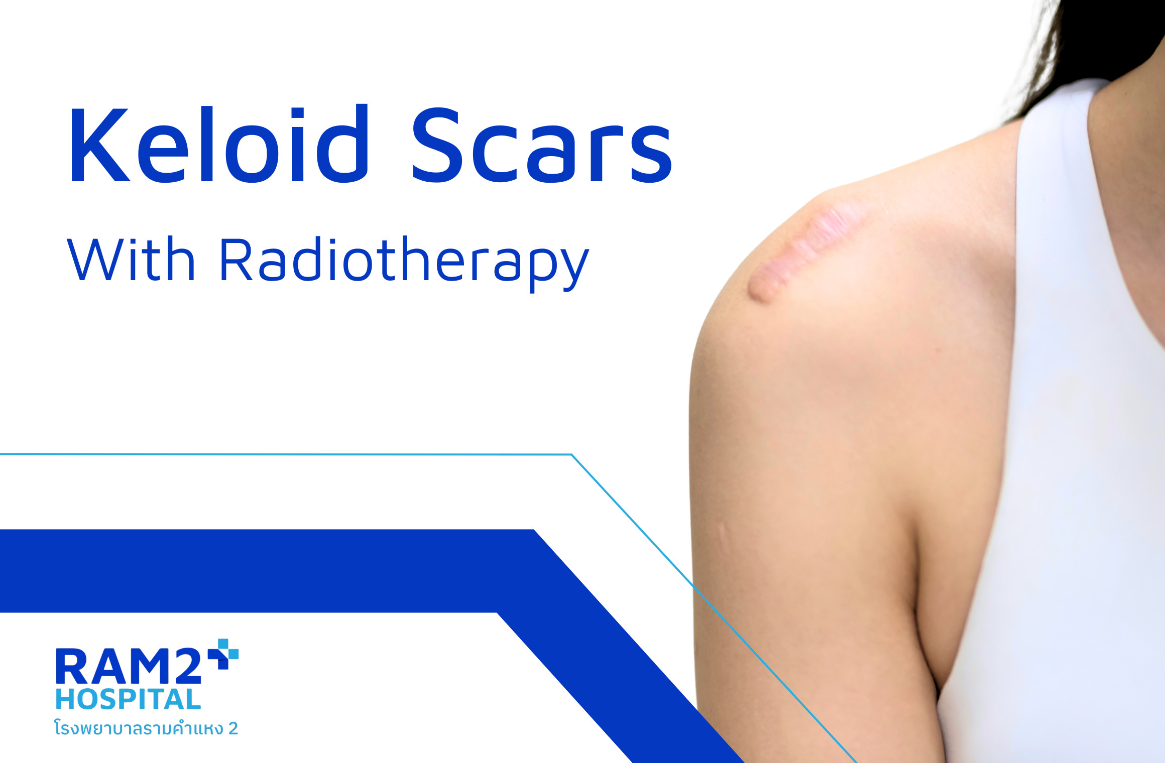 keloid scar with radiotherapy